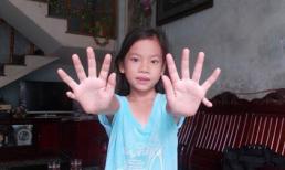 Kỳ lạ cô bé có 24 ngón tay, chân ở Quảng Nam