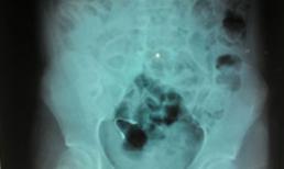 Ngủ dậy, phát hiện niềng răng lọt vào bụng