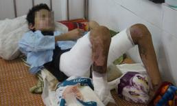 Mẹ đẩy con 11 tuổi vào đống lửa gây bỏng nặng