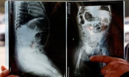 Em bé mọc kim khắp người tại Trung Quốc