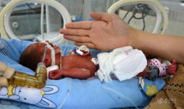 'Kỳ tích' bé sơ sinh nặng 0,8kg vẫn có thể sống sót