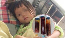 Ăn thịt bò tái, bé gái 4 tuổi bị nhiễm sán lá gan