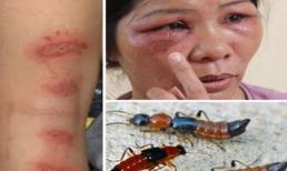 Điều trị viêm da do tiếp xúc với kiến ba khoang