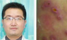 Kinh hãi 20 con dòi bò lúc nhúc, làm tổ dưới da người 