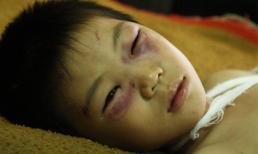 Bé 6 tuổi kể lại giây phút bị cha dượng đánh nứt sọ