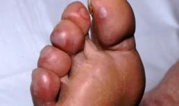 Mẹo hay trị ngay cước chân tay mùa lạnh