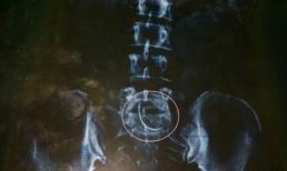 Mổ đẻ, bác sĩ 'quên' kim trong bụng bệnh nhân 9 năm