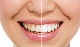 Bí quyết giúp răng trắng sáng