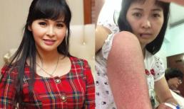 Ca sĩ Trang Nhung bị sốt xuất huyết nghiêm trọng