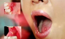 Biểu hiện không ngờ chứng tỏ bạn có nguy cơ bị ung thư miệng
