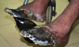 Khủng khiếp bàn chân bị phá hủy vì thuốc lá
