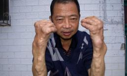 Bị nổi u chi chít vì nhiễm kim loại nặng