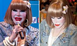 Gương mặt biến dạng gây sốc của 'thảm họa' thẩm mỹ Thái