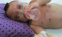 Bé trai 2 tuổi đầy thương tích nghi do bà ngoại đánh