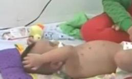 Bé trai 2 tuổi bị bà ngoại đánh đã ổn định sức khỏe