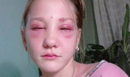 Ca sĩ nhí 13 tuổi suýt bị mù vì nhuộm mi