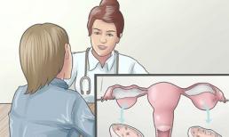 Dấu hiệu của hội chứng buồng trứng đa nang