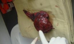 U khổng lồ trong phổi của bệnh nhân hút thuốc lá