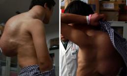 Người đàn ông có khối u nặng 10kg trên lưng