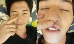 Hotboy Huỳnh Anh mặt mày bầm dập vì tai nạn và bị hôi của
