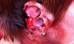 Kinh hoàng chồng cắn đứt tai vợ