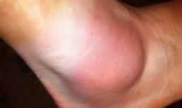 Bong gân: Xử lý đúng cách để tránh hậu quả nghiêm trọng