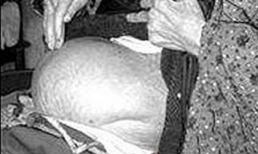 Cụ bà 76 tuổi ở Khánh Hòa mang thai đá