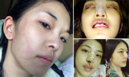 "Nữ hoàng dao kéo" Thái Lan tự tin khoe sẹo phẫu thuật