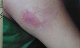 Anh rể cắn 'nhũ hoa' em vợ nhởn nhơ vì khó định tội danh?