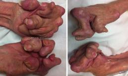 Đôi bàn tay biến dạng kinh hoàng do không điều trị viêm khớp