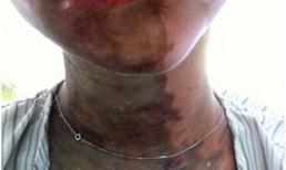 Bị khoét mắt, cắt tai và mũi vì tạt axit vào mặt cô gái trẻ