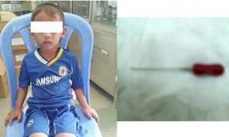 Bé 4 tuổi nuốt phải cây kim trong lúc lấy tủy răng