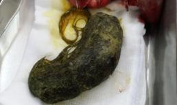 Ăn tóc suốt 2 năm, một bé gái bị thủng ruột