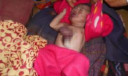 Bé trai chào đời với trái tim nhô ra khỏi lồng ngực