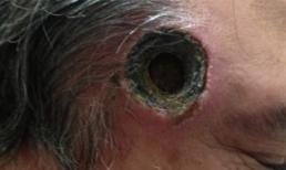 Bị thủng một lỗ đen trên thái dương do dùng thuốc mỡ bị cấm