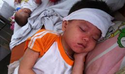 Cách chăm sóc trẻ mắc bệnh sởi