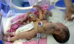 Cặp song sinh biến dạng, một bé trở thành tay chân gắn liền vào bé còn lại