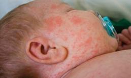 Những biến chứng nghiêm trọng của bệnh sởi