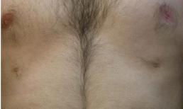 Người đàn ông mọc tới 6 núm vú trên cơ thể