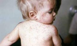 Những đại dịch sởi khủng khiếp trong lịch sử thế giới