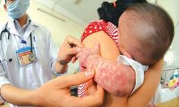 Bộ Y tế "giấu" dịch sởi cũng vì... nghĩ cho dân