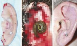 Phục hồi thính giác cho bệnh nhân bằng... đỉa