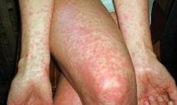 238 người lớn đã mắc sởi