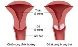 Một vài triệu chứng nhận biết ung thư cổ tử cung