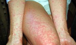 Sởi lành tính vẫn gây chết người như chơi