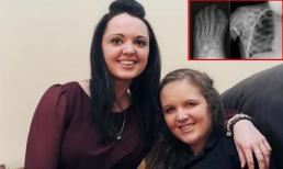 Cô gái có 2 bộ xương trong người