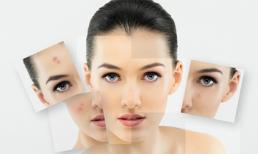 Trị mụn với công nghệ Green Laser hiện đại