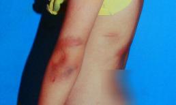 Phẫn nộ vụ mẹ kế hành hạ con chồng và chồng dã man