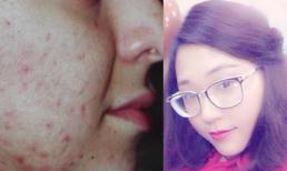 Cô gái 9X bỗng dưng... sạch mụn