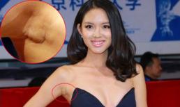 HH thế giới Trương Tử Lâm lộ sẹo nâng ngực khó chối cãi